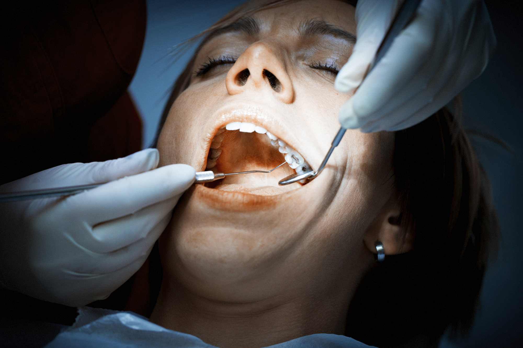 Getting a cavity filled can be a nerve-racking experience. We're here to help prepare you for the process with this detailed guide on what to expect.