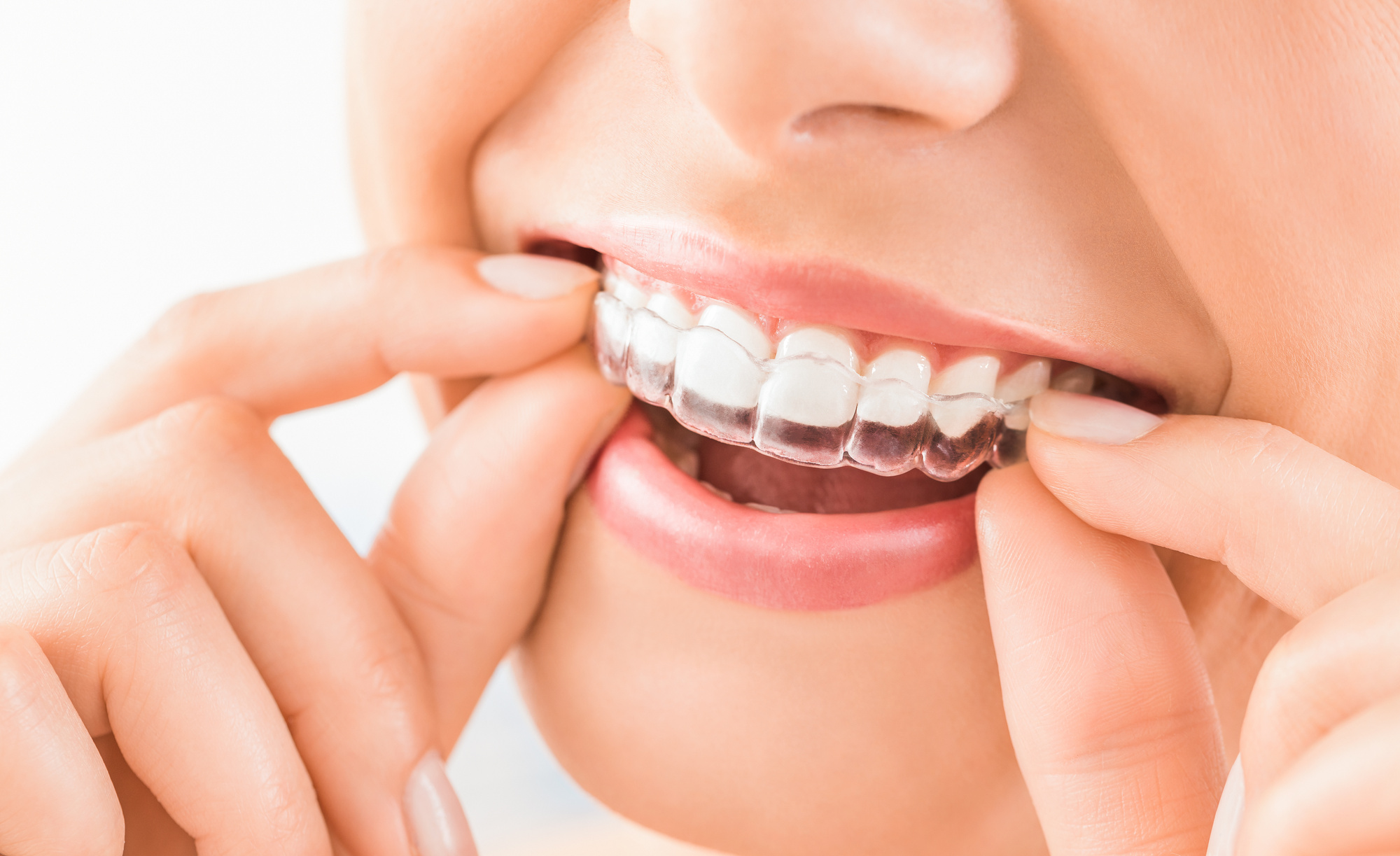 Crooked, misaligned, gappy, or overcrowded teeth can cause lots of health problems. Here are the amazing Invisalign benefits.